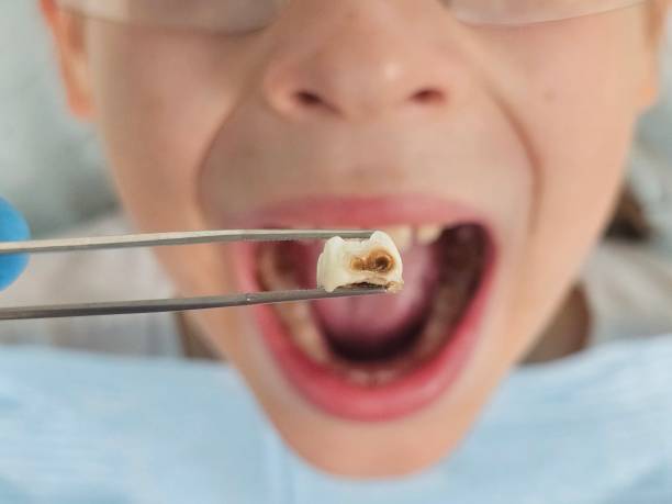 Best Chipped Tooth Repair Near Me  in Silver Lake, OH